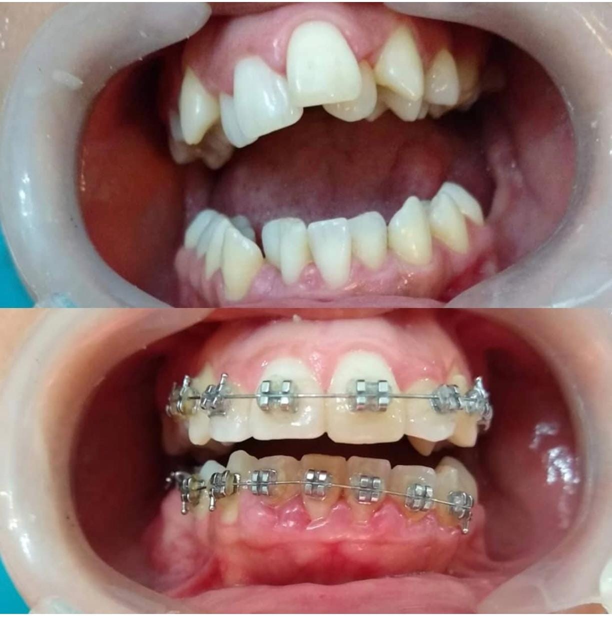 Tratamiento de ortodoncia con brackets metálicos