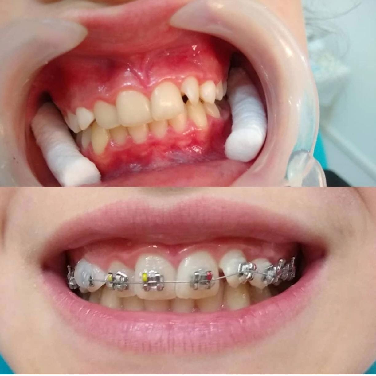 Caso real de ortodoncia con brackets - antes y después